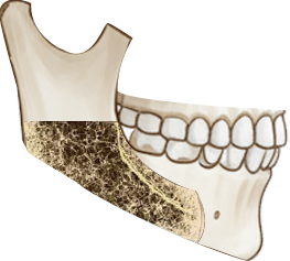 피질골 절제 도해