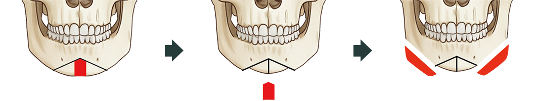 역V절골술 도해