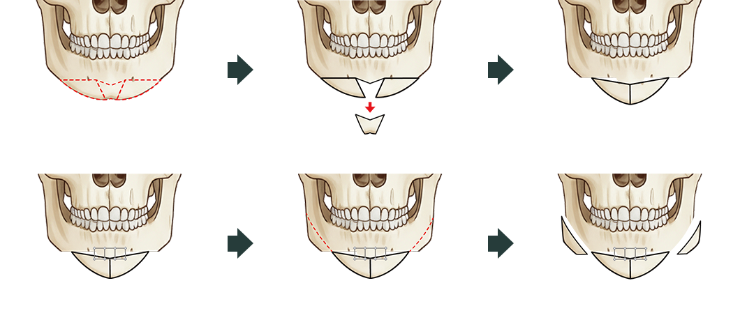 Y변형 절골술 도해