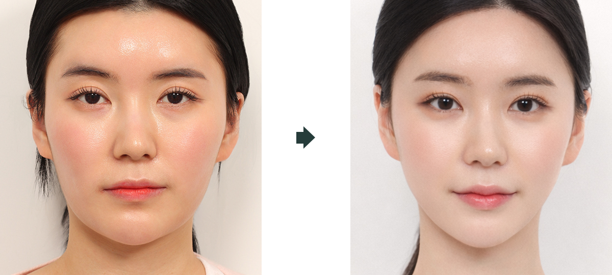 브이라인수술 전후 정면