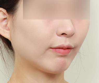 3D 광대축소술 측면 사진