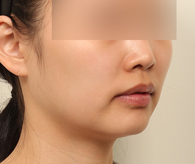 3D 광대축소술 측면 사진 2
