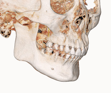 3D 광대축소술 X-ray 1