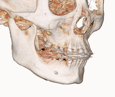 3D 광대축소술 X-ray 2
