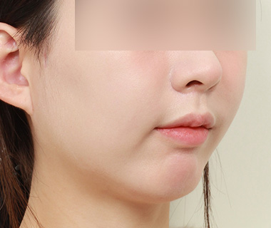 3D 광대축소술 수술 후 사진