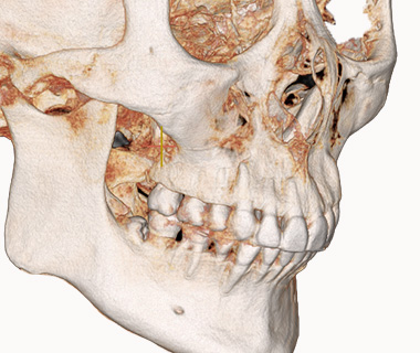 3D 광대축소술 수술 전 사진