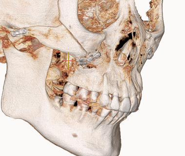 3D 광대축소술 수술 후 사진