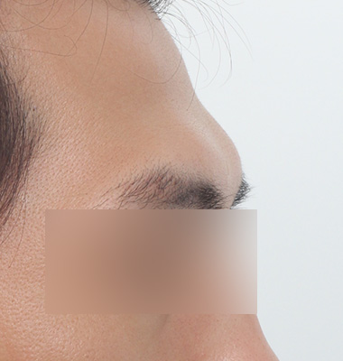 보형물 삽입술 수술 전후 사진 1