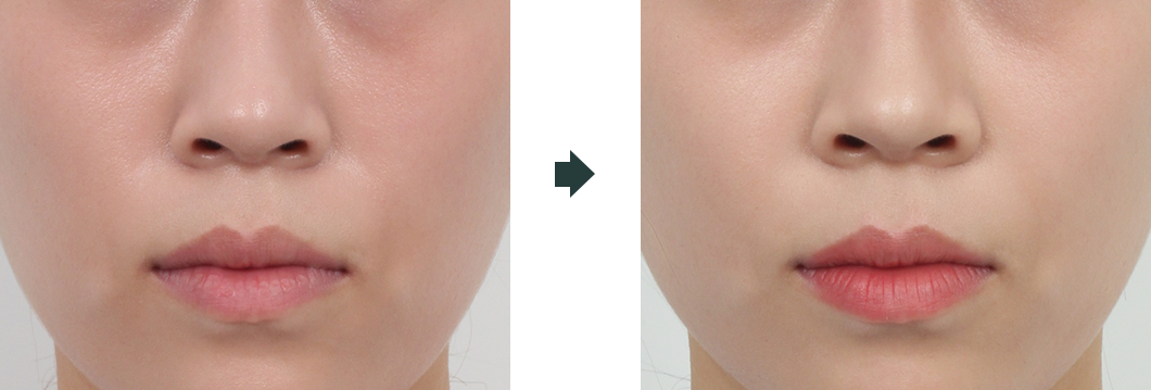 귀족 보형물 수술 전후 사진