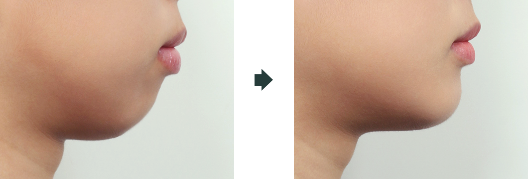 턱 끝 보형물 수술 전후 사진