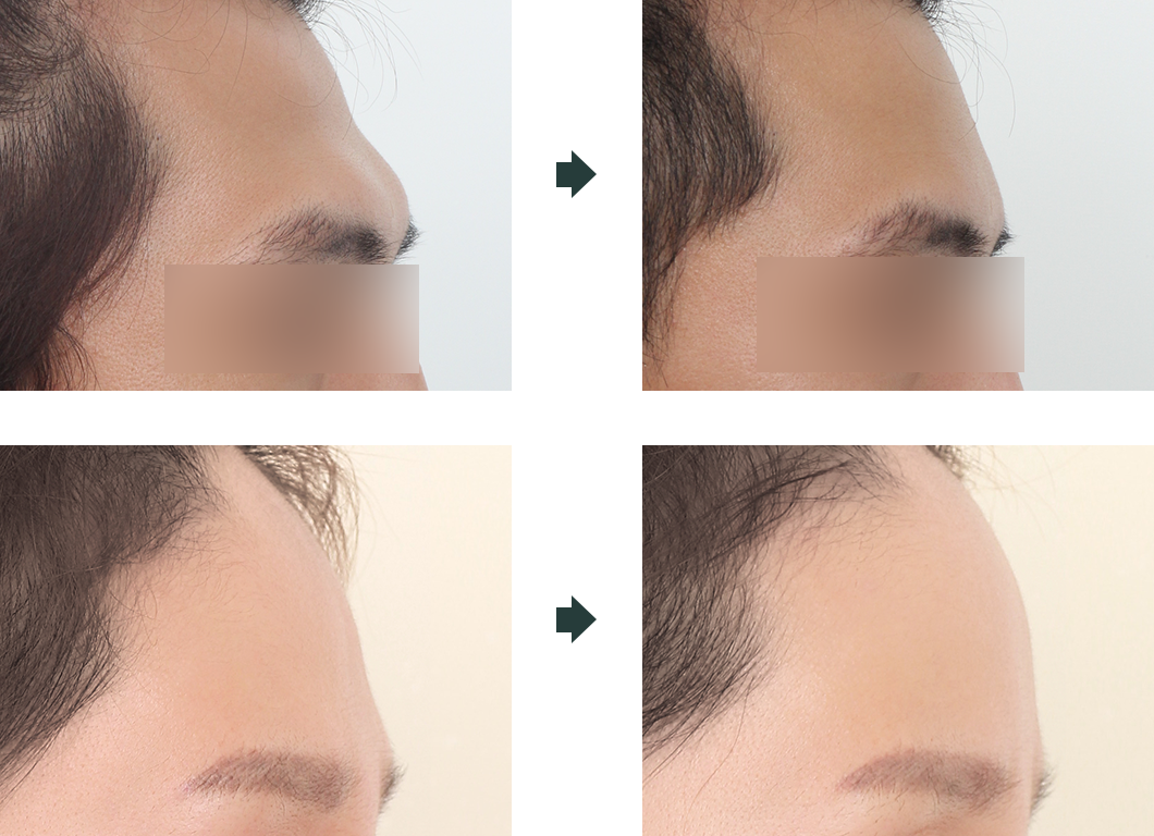 이마 보형물 수술 전후 사진