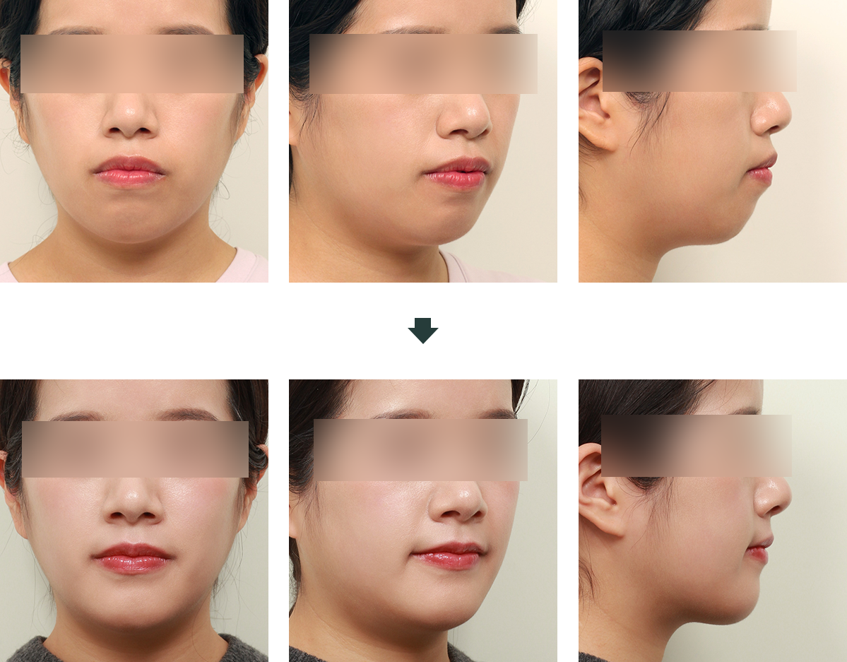 돌출입 수술 전후 사진