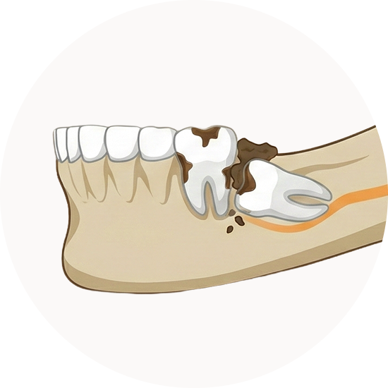 사랑니, 왜 문제가 될까요?