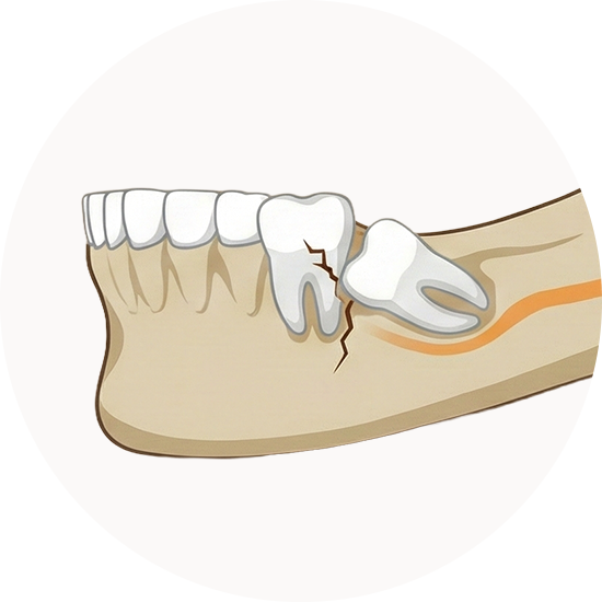 사랑니, 왜 문제가 될까요?