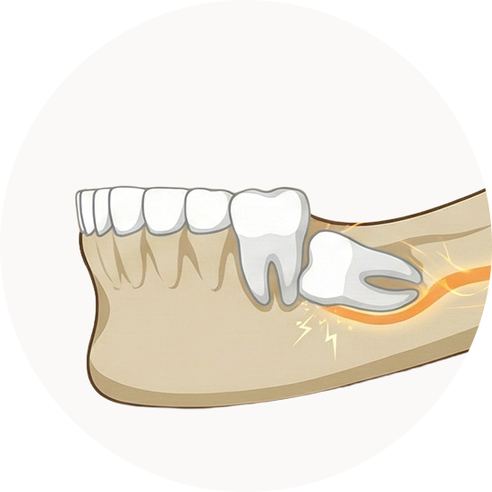 사랑니, 왜 문제가 될까요?