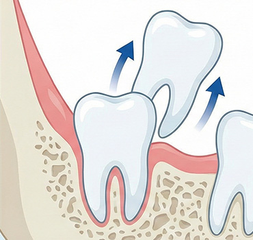 정상 맹출 사랑니
