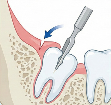 부분 매복 사랑니