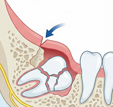 완전 매복 사랑니