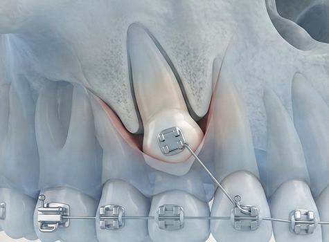 외과적 노출 수술