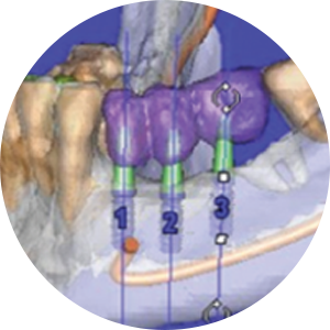 3D 디지털 모의수술