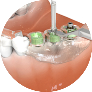 네비게이션 임플란트 수술