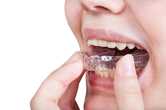 SSRO (시상분할 하악절골술) 수술 도해