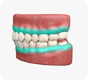 잇몸 보호제 도포