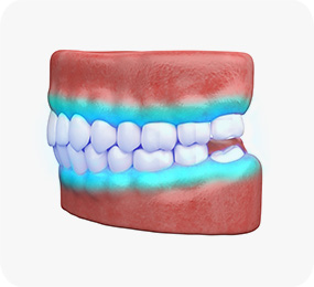 치아미백 약제 도포