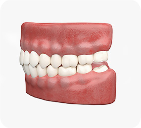 치아미백 광선 조사